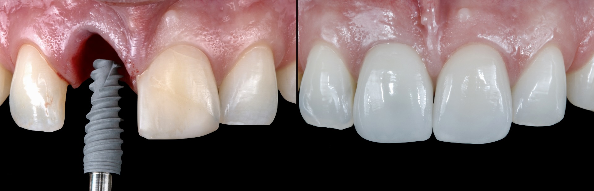 Implantes Dentários com Segurança e Tecnologia